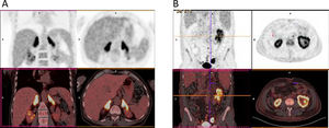 Proton emission tomography with fluorodeoxyglucose (PET-FDG) of two different patients. Patient 3 (A) PET-FDG (top row) and PET/computed tomography (CT) fusion (bottom row) showing focal increased uptake within adrenal glands. Patient 4 (B) PET-FDG (top row) and PET/CT fusion (bottom row) showing focal increased uptake within both kidneys, predominantly in the left.