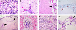 Photomicrographs of different organs from two patients. (A) Kidney photomicrograph from biopsy of patient 4, showing atypical intravascular cells in blood vessels (H&E). (B-H) Photomicrographs of autopsy from patient 6. Cerebral tissue with occlusion of a cortex blood vessel (B) and a leptomeningeal arteriole (C, black arrow) (H&E). Cerebellar tissue showing positive staining with the CD20 antibody of intravascular cells (D). Intraluminal atypical lymphocytes within blood vessels of the dermis (E, black arrow), myocardium (F), pancreas (G) and lung (H, black arrow) (H&E).