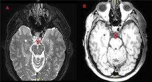 Observamos dicha lesión (flecha roja) en la superficie dorsal del clivus. En la imagen de la izquierda (A) vemos que tiene un aspecto hipointenso en T1 y que no capta contraste, mientras que en la imagen de la derecha (B) observamos que tiene un comportamiento hiperintenso en T2.