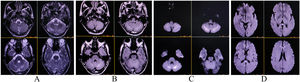 T2-weighted imaging (A) and T2-FLAIR (B) demonstrate hyperintensities in both cerebellar hemispheres, with diffusion restriction on diffusion-weighted imaging (C). Additionally, hyperintensity is observed in the splenium of the corpus callosum (D).
