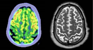 Caso 2. A la izquierda se presenta un corte axial de un 18F-FDG cerebral cerebral donde puede observarse un hipometabolismo perirrolándico bilateral (signo de la banda motora), que se corresponde con una zona de mayor atrofia en la RM cerebral a la derecha.
