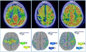 Se muestran arriba los cortex axiales de fusión de los estudios PET/TC 18F-FDG en cada caso (fila superior). En la fila inferior se muestra el análisis semicuantitativo mediante software CortexID con reconstrucción tridimensional cerebral, con valores de z-score. El caso 1 es el más claro de los 3, con una afectación en rango muy patológico y bilateral. En el caso 2 la afectación es asimétrica, cuantitativamente menos llamativa pero patológica especialmente en el lado derecho (esta afectación más leve se corresponde con el paciente con menor grado de certidumbre en el diagnóstico). En el caso 3 la afectación es claramente asimétrica, peor derecha, concordante con la clínica del paciente (mayor afectación hemicorporal izquierda).