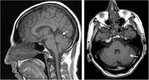 Brain MRI: sagittal and axial T1-weighted sequences showing predominantly vermian but also hemispheric cerebellar atrophy in a patient with ataxia associated with downbeat nystagmus due to the FGF14 GAA expansion.