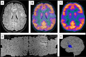 Images showing left opercular bottom of sulcus focal cortical dysplasia type II. (A) Axial FLAIR sequence on 3T MRI. (B) Fusion of images (A) and (C). (C) Axial FDG-PET sequence at the location of FCD. (D) Mercator reconstruction, based on FLAIR sequences. (E) 3D MRI volumetric reconstruction.