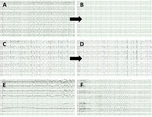 EEG recordings corresponding to false negatives and false positives. (A) False negative. Patient 34 presents rhythmic spikes predominantly in the vertex, coinciding with generalised subtle jerks. (B) EEG from the same patient, following intravenous administration of 0.5mg clonazepam. (C) False negative. EEG recording from patient 52 shows bifrontal spike, spike-wave, and polyspike-wave discharges, with no clinical manifestations. (D) EEG recording from the same patient, following intravenous administration of 0.5mg clonazepam. (E) False positive. Patient 47 shows background activity slowing, sometimes following a rhythmic pattern, without clear progression and with no clinical manifestations. (F) EEG recording from patient 18 revealing frontal intermittent rhythmic delta activity.
