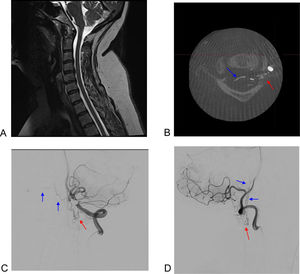 Fístula dural espinal cervical. A)Corte sagital de resonancia magnética en secuencias T2 que muestra la ausencia de alteraciones a nivel de médula cervical. B-D)Reconstrucción 3D (B), arteriografía por sustracción digital en proyección anteroposterior (C) y en proyección lateral (D) que muestran el punto de fístula (flecha roja) y su drenaje venoso locorregional (flechas azules).