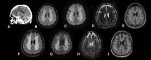 Tomografía computarizada cerebral inicial con hipodensidad difusa en sustancia blanca (A). Resonancia magnética cerebral a los 7 días que muestra una hiperseñal difusa en sustancia blanca subcortical y periventricular en Fluid-Attenuated Inversion Recovery (T2-FLAIR) (B); e incremento de señal en secuencia de difusión (C); con su correspondiente hipointensidad en la periferia de la sustancia blanca en el mapa de difusión aparente (D); y discreta hipointensidad en secuencia T1 en la sustancia blanca (E). Resonancia magnética cerebral a los 21 días que muestra incremento de la hiperseñal de la sustancia blanca en FLAIR (F) y progresión del edema citotóxico junto con cavitaciones en la sustancia blanca profunda en secuencia de difusión (G) y mapa de difusión aparente (H) y con mayor hipointensidad en secuencias T1 sugiriendo la presencia de cambios necróticos (I).
