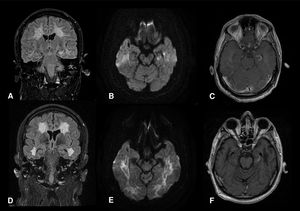 Resonancia magnética cerebral a los 7 días que muestra alteración de la señal hipocampal izquierda con patrón de restricción en la DWI y captación de contraste (A, B, C); resonancia magnética cerebral a los 21 días del ingreso que muestra una discreta disminución del tamaño hipocampal previa con persistencia de la captación indicativo de rotura de la barrera hematoencefálica (D, E, F).