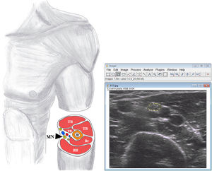 Ultrasonographic scan of the median nerve. The CSAmn is delimited with a dotted yellow line. BB: biceps brachialis muscle; Br: braquialis muscle; CSAmn: cross sectional area of the median nerve; TB: triceps brachialis muscle; black arrowhead, median nerve.