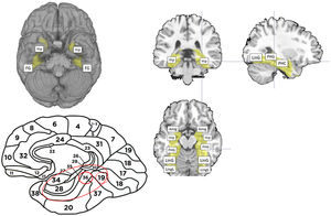 Zonas del cerebro utilizadas en la máscara inclusiva en el paradigma de memoria. A) Proyección caudal del cerebro, con activación de ambos hipocampos y giro fusiforme (FG). B) Proyección lateral del cerebro que muestra las áreas de Brodmann incluidas en el análisis (B16, 16, 36,37). C) Figura superior izquierda: corte en plano coronal que muestra los hipocampos bilaterales incluidos en el paradigma. Figura superior derecha: Corte sagital que muestra giro parahipocampal (PHG), parahipocampo (PHC) y giro lingual (LinG). Figura inferior: Plano transversal que muestra zonas anatómicas incluidas en la máscara de memoria, en sentido anteroposterior se encuentran respectivamente: Amígdala (Amig), hipocampo (Hip), giro parahipocampal (PHG), giro lingual (LinG) y lóbulo lingual (LingL).