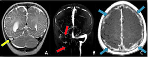 (A) Coronal T2 demonstrates absent flow void in the right transverse sinus (yellow arrow); (B) MRV (3D reconstruction), exhibits absent flow signal in the right transverse and sigmoid sinuses as well as ipsilateral jugular vein (red arrows); (C) Axial T1post-GAD showing diffuse pachymeningeal and leptomeningeal enhancement (blue arrows).