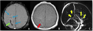 (A) Axial depicts SWI, hypointensity (“blooming effect”) along a cortical vein located in the high convexity (green arrow) indicating the presence of thrombus and sub-arachnoid hemorrhage (blue arrows); (B) axial T1WI reveals spontaneous hyperintensity in a cortical vein located in the high convexity on the right – endoluminal thrombus; (C) MRV (3D reconstruction), poor visualization of the cortical veins draining into the superior sagittal sinus, which is itself patent.