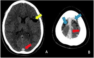 Axial brain CT without contrast administration obtained 18 years after the primary event shows a left frontal cortico-subcortical vascular sequela (yellow arrow) as well as hyperdensity within the superior sagittal sinus (red arrows) and cortical veins in the high convexity (blue arrows) in keeping with recurrent cerebral venous thrombosis.