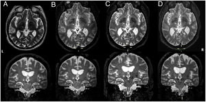 Axial and frontal views of a postoperative 3D T2-weighted MRI (A) and 1 month (B), 1 year (C) and 3 years (D) MRI controls showing left MRI-guided focused ultrasound (MRIgFUS) thalamotomy. L (left side). R (right side).