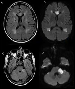 CEREBRAL MRI, (A–C) FLAIR and (B–D) DWI, performed on the 5th postoperative day. Multiple acute and subacute ischemic lesions were observed at the level of the supratentorial white matter, corpus callosum and left cerebellar peduncle (C). Bilateral hyperintensity in the temporal pole (O'Sullivan's sign).