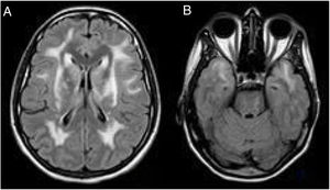 Cerebral MRI scan (A–B FLAIR) of the patient's sister, showing extensive diffuse signal alteration in the cerebral white matter.