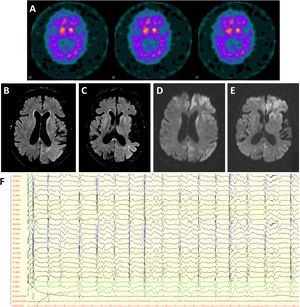 (A) DaTSCAN revealing bilateral decreased of dopamine transporter availability in the putamen. (B, C) Brain MRI showing diffuse cortical atrophy predominantly in the temporal lobes and hyperintensity in basal ganglia and parieto-temporal transition on Fluid attenuated inversion recovery (FLAIR). (D, E) Diffusion restriction in caudate and lenticular nucleus, as well as antero-medial frontal, insular and temporo-parietal cortex on DWI (diffusion-weighted magnetic resonance imaging). (F) Electroencephalogram revealing generalized periodic discharges at 0.5–1.5Hz with triphasic waves.