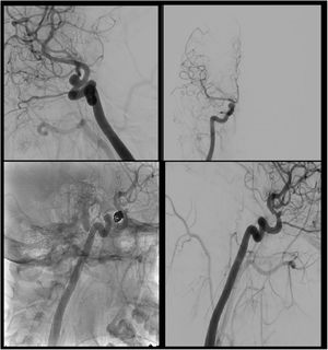 Arteriografía cerebral. En las dos imágenes superiores se muestran imágenes de la arteriografía diagnóstica en fase arterial tardía, proyección oblicua (primera imagen) y anteroposterior (segunda). En las imágenes tercera y cuarta se observa el resultado de la embolización del aneurisma mediante coils.