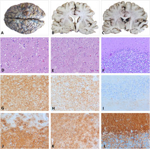 Histopatología post mortem. A-C)Estudio macroscópico: encéfalo y cortes coronales a nivel de ganglios basales y tálamo que revela una mínima atrofia en la corteza temporal sin otros cambios relevantes. Córtex parietal (D, G y J): pérdida neuronal y moderada espongiosis del neuropilo con vacuolas redondeadas de pequeño-mediano tamaño con HE (D). El estudio inmunohistoquímico (IHQ) reveló un depósito de la PrP con patrón granular-sináptico difuso (G) y una marcada gliosis astrocitaria reactiva con la GFAP (J). Tálamo (E, H y K): pérdida neuronal con mínima espongiosis y severa gliosis astrocitaria con la HE (E) y GFAP (K). Presencia de proteína priónica de forma más discreta que en la corteza (H). Cerebelo (F, I y L): moderada pérdida de neuronas granulares y de células de Purkinje con la HE (F) con presencia de pequeños focos de PrP en la capa de células granulares (I) y gliosis astrocitaria con la GFAP (L). GFAP: proteína ácida fibrilar glial; HE: hematoxilina-eosina; PrP: proteína priónica.