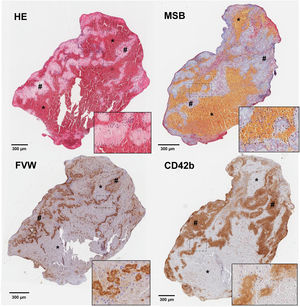 Cortes histológicos de trombo de paciente con ictus isquémico con las siguientes tinciones: hematoxilina-eosina (H&E); Martius Scarlet Blue (MSB); inmunotinción específica para el factor de Von Willebrand (FVW); e inmunotinción específica para plaquetas CD42b+. Se marcan con (*) las áreas ricas en plaquetas y con (#) las zonas ricas en eritrocitos. En la esquina inferior derecha de cada imagen se facilita un aumento ×20 de las áreas señaladas. Fuente: Imágenes cedidas por el Laboratorio de Aterotrombosis, CIMA/Universidad de Navarra.