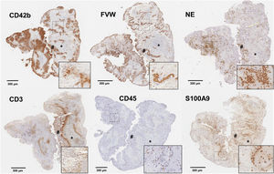 Cortes histológicos de trombo de paciente con ictus isquémico con las siguientes inmunotinciones específicas para: plaquetas CD42b+; factor de Von Willebrand (FVW); elastasa de neutrófilos (NE); linfocitos CD3+; leucocitos CD45+; y calprotectina (S100A9). Se marcan con (*) las áreas ricas en plaquetas y con (#) las zonas ricas en eritrocitos. En la esquina inferior derecha de cada imagen se facilita un aumento ×20 de las áreas señaladas. Fuente: Imágenes cedidas por el Laboratorio de Aterotrombosis, CIMA/Universidad de Navarra.