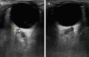 Spot sign found at the transorbital sonographic evaluation of the central retina artery in a patient with vision loss in the right eye. (A) Right eye. A hyperechogenic spot (yellow arrow), compatible with calcium-rich emboli, can be found at the central retina artery. (B) Left eye. No pathological findings.