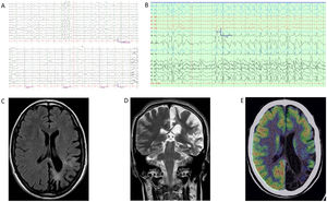 Complementary studies of patient 1. (A) EEG (2020). Bipolar circular montage showing discrete diffuse slowing of brain bioelectrical activity. Paroxysmal focality of irritative characteristics of occasional expression (single burst) in the left anterior temporal region with contralateral transmission. (B) EEG (2022). Bipolar circular montage showing slightly slowed background activity with expressive paroxysmal activity in the left fronto-centro-temporal region. Very frequent discharges of spikes and waves at 2–2.5Hz, of 10 seconds’ duration, over the left and central fronto-temporal region (Fp1, F7, Fz), with transmission to contralateral homologous regions. During sleep, the discharges became much more frequent and present greater amplitude and tendency to diffusion. (C) Brain MRI (2010). The FLAIR-weighted image shows prominent cortical atrophy over the left hemisphere with frontal lobe preservation, white matter hyperintensity, and ipsilateral ventricular retraction. (D) Brain MRI (2020). A: Coronal T2-weighted image. B: Axial FLAIR-weighted image. Both images show cortical atrophy associated with extensive gliosis affecting the left parietal and occipito-temporal lobe, associated with ventricular retraction. (E) 18F-FDG PET, co-registered with MRI (2021). Severe hypometabolism or absence of uptake associated with appreciable cerebral atrophy of left temporal and occipital predominance. Hypometabolism and atrophy were also seen in the superior fronto-parietal medial cortex. Moderate hypometabolism was observed in the left temporal pole in the areas with less cortical thickness. The left striatum and left posterior thalamus showed mild hypometabolism. No significant findings were observed in the cerebellum. Results showed the absence of hypermetabolism suggesting inflammatory activity or functional increment by ictal activity. 18F-FDG PET: positron emission tomography with 2-deoxy-2-[fluorine-18] fluoro-d-glucose; EEG: electroencephalography study; FLAIR: fluid-attenuated inversion recovery; MRI: magnetic resonance imaging.