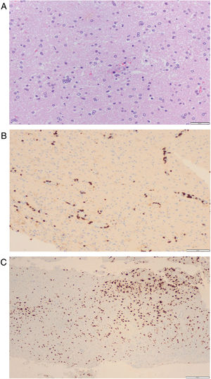 Brain histopathological examination of patient 2. Brain biopsy histopathological findings. (A) Hematoxylin–eosin staining with perivascular and diffuse lymphocyte infiltration and a microglial nodule. (B) CD8 immunohistochemistry with marked perivascular and parenchymal CD8+ T lymphocytes. (C) NeuN immunohistochemistry with patchy areas of cortical neuron loss.