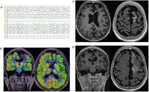 Complementary studies of patient 2. (A) EEG (2020). Bipolar circular montage showing normal background activity, with slow spike and wave paroxysms collected in the temporal region of the left hemisphere. (B) Brain 18F-FDG PET (2022). Left frontal, striatal, and thalamic hypometabolism. (C) Brain MRI (2019). Axial FLAIR-weighted image and coronal FLAIR-weighted image. Left frontal parasagittal lesion without gadolinium enhancement or mass effect, and very mild left hemispheric atrophy. (D) Brain MRI (2020). Axial and coronal FLAIR-weighted images showing significant growth of the lesion over the left frontal lobe, parietal lobe, and periventricular area, without gadolinium enhancement or mass effect, as well as notable ipsilateral atrophy. 18F-FDG PET: positron emission tomography with 2-deoxy-2-[fluorine-18] fluoro-d-glucose; EEG: electroencephalography study; FLAIR: fluid-attenuated inversion recovery; MRI: magnetic resonance imaging.