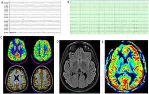 Complementary studies of patient 3. (A) EEG (2019). Referential average montage showing normal background activity with superimposition of occasional right frontal spike-and-wave paroxysms, with slight diffusion to contralateral homologous regions. (B) Video-EEG (2021). Bipolar circular montage showing normal background activity with superimposition of frequent spike and spike-and-wave paroxysms in the right fronto-parietal area (C4, Fp2, F8), with great tendency to diffusion to the central area; occasional periodic presentation. These paroxysms most often appeared in phase N2<N3<REM. Arrhythmic focal myoclonus with no EEG correlation. (C) 18F-FDG PET, co-registered with brain MRI. Axial image. Hypometabolic foci in the right frontal lobe; the extent and severity of hypometabolism may be overestimated due to a seizure that occurred before the PET-CT study was conducted. The right cerebellar hemisphere presents hypometabolism. (D) Brain MRI (2022). The image shows 2 T2-hyperintense lesions in the basal region of the right frontal lobe, associated with discrete cortical atrophy and juxtacortical gliosis. (E) Brain ASL MRI (2022). Right frontal hypoperfusion. 18F-FDG PET: positron emission tomography with 2-deoxy-2-[fluorine-18] fluoro-d-glucose; ASL: arterial spin labeling; EEG: electroencephalography study; FLAIR: fluid-attenuated inversion recovery; MRI: magnetic resonance imaging.