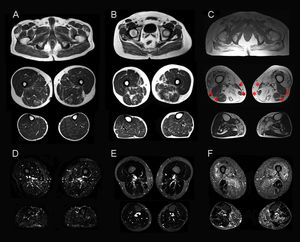 Muscle MRI studies of the lower limbs in symptomatic patients. Muscle imaging of sHypoPP patients showed different degrees of fatty degeneration in T1-weighted axial images. Patients without permanent weakness (A and B) showed a moth-eaten appearance with scattered small areas of increased signal in the gluteus major muscle and in the muscles of the posterior compartment of the thigh (particularly the adductor magnus and semimembranosus muscles), while an incipient involvement of the soleus muscle was observed only in B. A patient with permanent weakness (C) showed end-stage fatty degeneration in the gluteus major and thigh muscles, sparing the biceps femori, semitendonosus, sartorius, and gracilis muscles (asterisks). In the lower legs, the soleus and gastrocnemius medialis showed pronounced degeneration. STIR sequences showed hyperintensity only in muscles with permanent weakness (F), but were normal in patients with recurrent attacks but not permanent weakness (D, E).