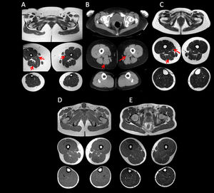 Muscle MRI studies of the lower limbs in asymptomatic carriers. Muscle imaging of the 3 asymptomatic carriers (A–C), showed atrophy and very mild fatty degeneration of the adductor magnus and semitendinosus muscles (arrows), with less marked involvement of the muscles of the posterior compartment of the thighs, and atrophy of the gluteus major muscle. This pattern is similar to that initially observed in sHypoPP. MRI findings in controls from the same families were all normal (D, E).