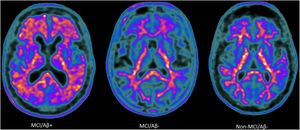 Amyloid-PET scans ([18F]Florbetaben) of representative patients from each group: MCI/Aβ+ participant (left) showing intense amyloid burden in most cortical areas (positive finding); MCI/Aβ− (center) and non-MCI/Aβ− participants (right) showing normal uptake in the white matter (negative finding).