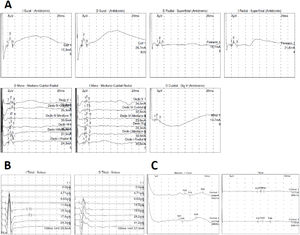 Estudio neurofisiológico compuesto por electroneurograma sensitivo (A), reflejo H (B) y potenciales evocados somatosensoriales (C). Las imágenes muestran parte del estudio neurofisiológico realizado al paciente. La primera imagen (A) expone las conducciones nerviosas sensitivas tanto en las extremidades superiores (nervios mediano, cubital y radial bilateral) como inferiores (nervio sural bilateral). En las extremidades superiores se pone de manifiesto una disminución de amplitud de los potenciales sensitivos asociado a una afectación difusa de la velocidad de conducción en relación con la lesión axonal secundaria, tanto en estudios orto como antidrómicos, lo que demuestra una afección de fibra no longitud dependiente. Los reflejos H (B) están ausentes de forma bilateral. En cuanto a los potenciales evocados somatosensoriales (C) se evidencia una amplitud disminuida y latencias retrasadas de forma bilateral en las extremidades inferiores, mientras que en las extremidades superiores es el lado derecho donde se obtienen respuestas patológicas con latencias retrasadas y peor estructuradas que en el lado contralateral, evidenciando una clara asimetría.