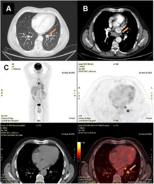 Estudio de imagen de extensión. Las imágenes muestran parte del estudio de imagen de extensión realizado al paciente, con objetivo de descartar una neoplasia oculta. En primer lugar (A) se muestra una imagen de tomografía computarizada torácica que revela una lesión pulmonar nodular, de 21mm de diámetro mayor, en el lóbulo inferior izquierdo con adenopatías prevasculares (12mm la de mayor tamaño) (B), infracarinales (21mm la de mayor tamaño) e hiliares bilaterales (17mm la de mayor tamaño en el lado derecho). La tomografía por emisión de positrones-tomografía computarizada (PET-TC) que aparece en la siguiente imagen (C) muestra hipermetabolismo del nódulo pulmonar y de las adenopatías mediastínicas.