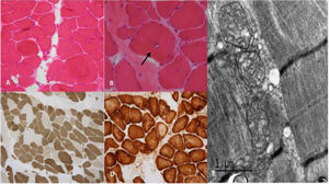 Histologic and histochemical study. Light microscopy, frozen sections. The H&E stain (A 200×, B 400×) shows increased variability in size and shape of muscle fibers and nuclear internalization (A). Rimmed vacuoles (arrow) are identified in some muscle fibers (B). In myosin ATPase-reacted section (200×) staining shows a mosaic pattern though with a predominance of type 1 muscle fibers (C). COX staining (200×) shows absence of staining in central core-like areas in some fibers (D). Electron microscopy shows mitochondria with elongated cristae but tubular aggregates were not found (E).