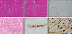 Biopsia muscular. Las imágenes muestran varios cortes de músculo esquelético estriado en las que se objetiva moderada variabilidad en el tamaño de fibras (a) con grupos de fibras anguladas atróficas (asterisco), fibras regenerativas (puntas de flecha) y ocasional miofagocitosis (b; asterisco) en tinciones de hematoxilina-eosina (H-E). La tinción mediante ATPasa 4,2 demostró la presencia de fibras de diferentes tipos (b). En tinciones de inmunomarcaje se observan macrófagos CD-68 positivos en endomisio y en el interior de las fibras musculares (d), linfocitos CD-3 positivos dispersos (e) y tinción positiva para HLA de tipo 1 con tinción intensa de la membrana y pequeña extensión al sarcoplasma (f).