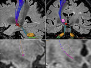 Modelo representativo de la aproximación realizada para la obtención de las coordenadas del área de tratamiento (se representa en amarillo el núcleo dentado, en rojo el núcleo rojo y en rosa el núcleo ventral intermedio del tálamo).