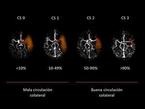 Categorías de circulación colateral analizadas de forma automatizada mediante Brainomix Ltd. CS: collateral score (categoría de circulación colateral).