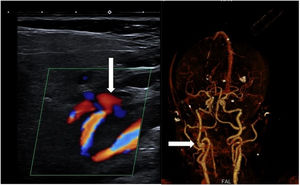 Ecografía dúplex y reconstrucción de angio-TC en la que se aprecia la imagen de aneurisma disecante en paciente con antecedentes de disección de la arteria carótida interna derecha.