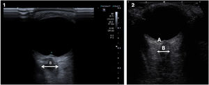 Ecografía orbitaria, modo B. En 1 se muestra papiledema que sobresale en el globo ocular (A), nervio óptico (B) y vaina del nervio óptico (flecha). En 2 se ilustra la ecografía orbitaria normal: papila(A), nervio óptico (B) y vaina del nervio óptico (flecha). Imagen cortesía del Dr. Rodríguez Pardo de Donlebún.