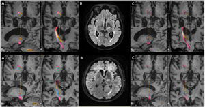 Magnetic resonance images from 2 patients with refractory tremor secondary to multiple sclerosis, treated with MRgFUS thalamotomy. Top row, patient 1. Bottom row, patient 2. (A) Stereotactic planning. MRI images (axial, sagittal, and coronal views) with tractography. Corticospinal (pink); medial lemniscus (blue), and dentate-rubro-thalamic (DRT) tract (orange). (B) FLAIR sequence, axial plane, after thalamotomy. (C) Tractography showing the disappearance of the DRT tract after thalamotomy.