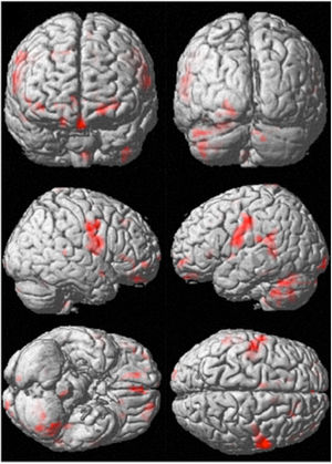 Functional Magnetic Resonance Image (fMRI). Significant activation sites when LC>visual baseline. Significant clusters at uncorrected p<0.001 and #voxels > 10. All clusters with FWE-corrected p>0.05 and a peak with FWE-corrected p<0.05 are shown. Activation sites can further be consulted in Table 2.