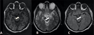 Axial MR images showing a well-defined intra-axial lesion with a bubbly appearance in the left hippocampus, which is heterogeneously hypointense on T1 (A), heterogeneously hyperintense on T2 (B) and FLAIR images (C).