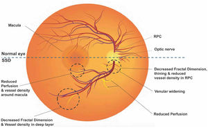 Retinal vascular alterations in SSD observed through fundus imaging. Key vascular abnormalities in the retina of patients with SSD are compared to the normal eye. In SSD, multiple vascular abnormalities are highlighted with dashed circles, including reduced perfusion and vessel density surrounding the macula; decreased fractal dimension and vessel density within the deep layers of the retina; thinning and reduced vessel density in the retinal peripapillary capillaries (RPC); and venular widening near the optic nerve. These vascular alterations correspond to decreased blood flow throughout the retina. These findings suggest that retinal vascular imaging may provide accessible biomarkers for SSD, reflecting the microvascular pathology that may parallel neurovascular changes in the brain of individuals with SSD.
