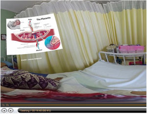 Display of anatomy of the placenta.