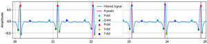 Results of QRS detection on subject 14.