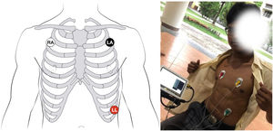 3-Lead electrode lay.