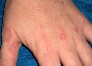 Granuloma anular | Piel. Formación continuada en dermatología