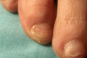 Onicomicosis blanca superficial debida a Fusarium oxysporum. Puede ser la puerta de entrada en una fusariosis diseminada.